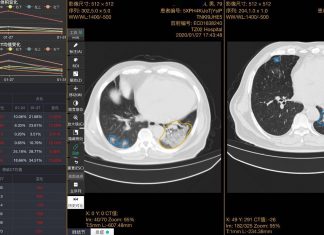 Using AI for Covid-19 detection